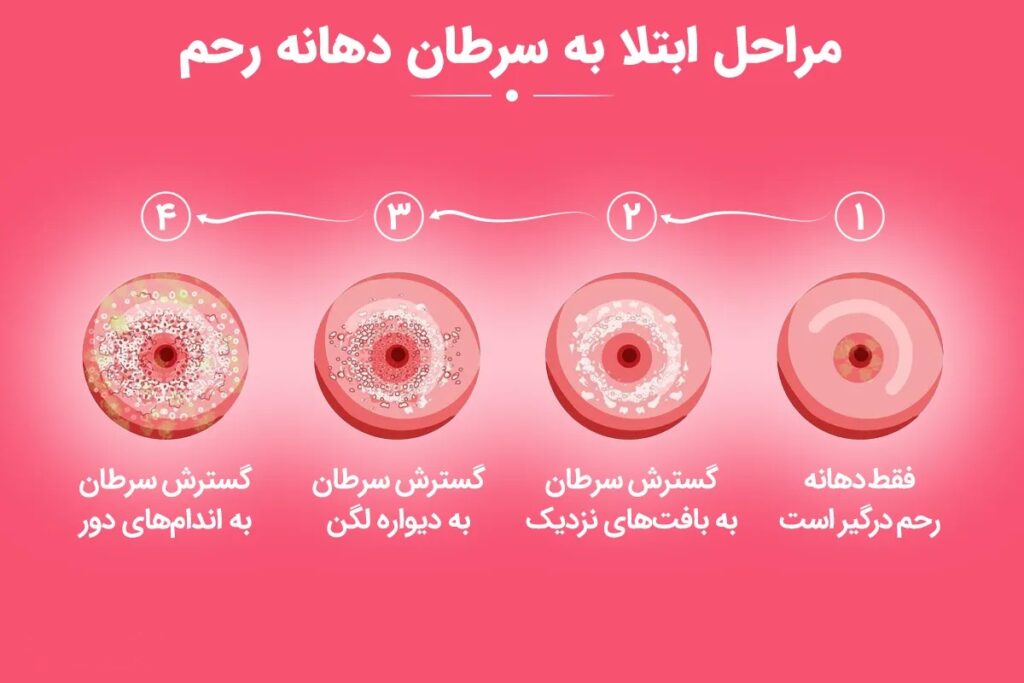 سرطان رحم