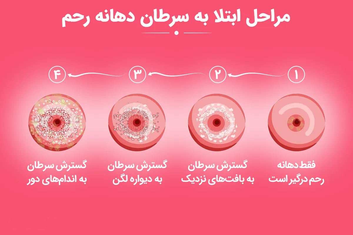 سرطان رحم