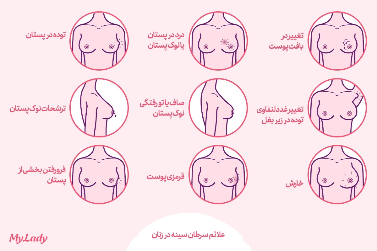 سرطان سینه