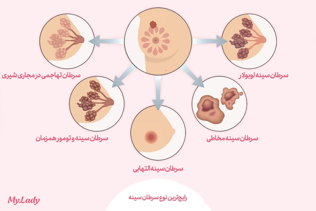 انواع سرطان سینه