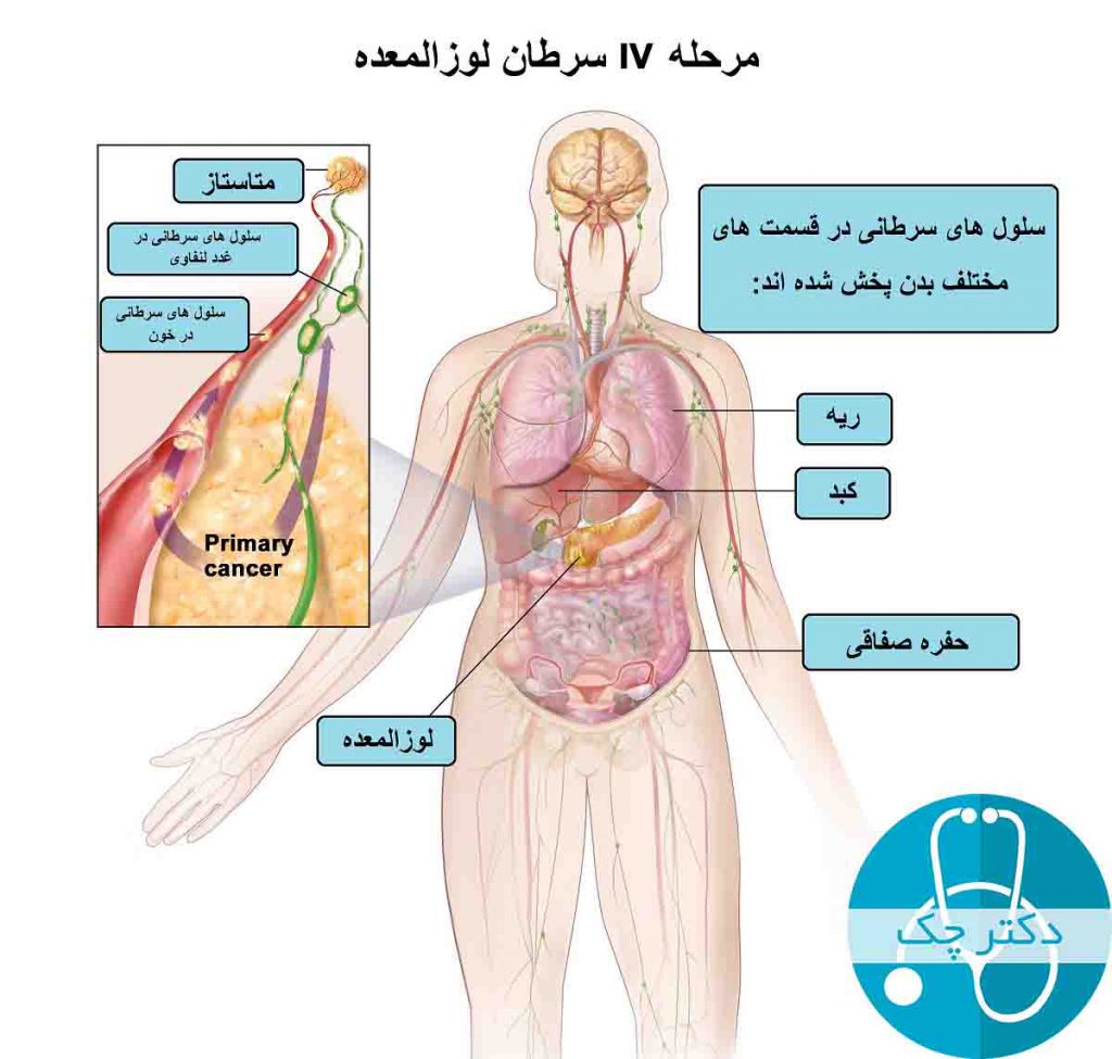 انواع و مراحل سرطان لوزالمعده