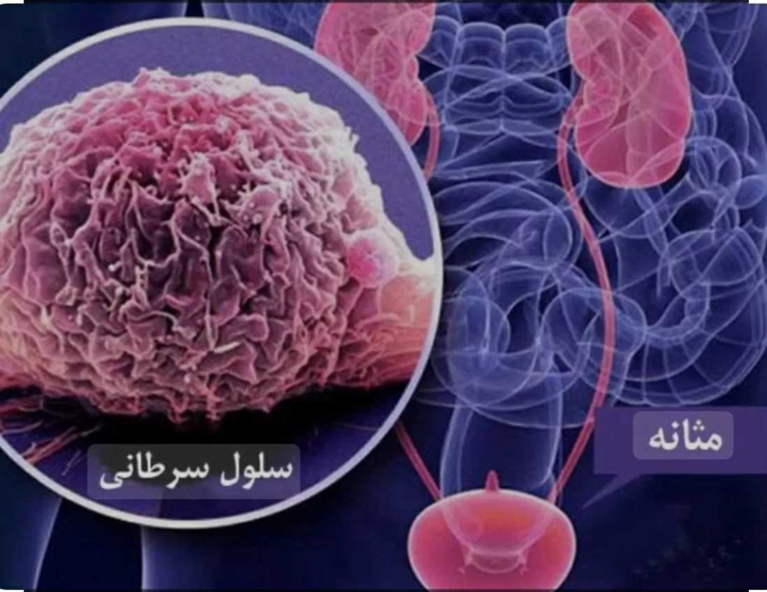 سرطان مثانه