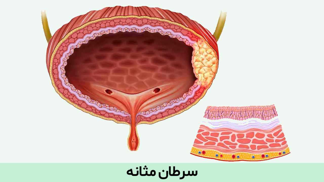 روشهای درمان سرطان مثانه