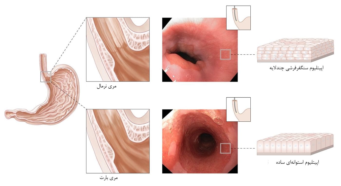 انواع سرطان مری