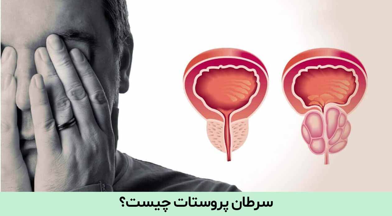 علائم سرطان پروستات