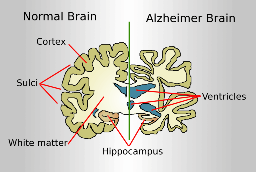 بیماری آلزایمر Alzheimer's disease