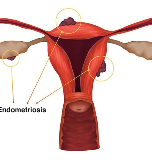 بیماری آندومتریوز