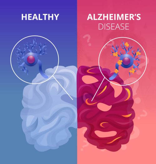 بیماری آلزایمر