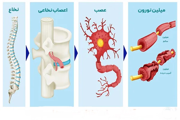 علائم بیماری ام اس