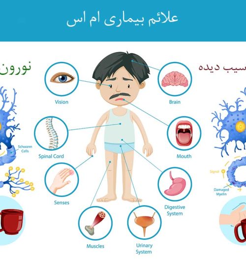 بیماری ام اس چیست