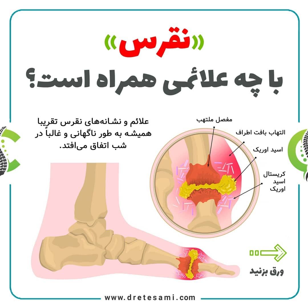 علائم و نشانه های نقرس