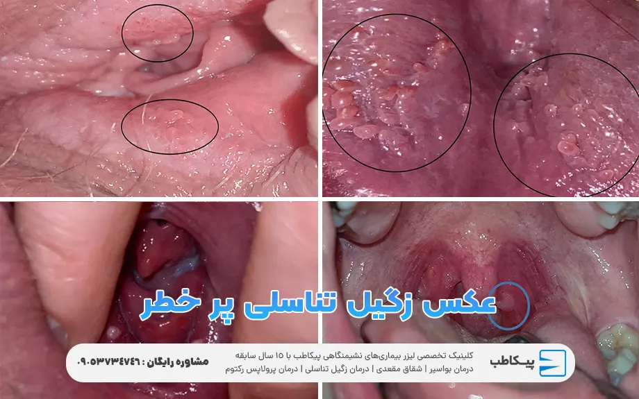 درمان زگیل تناسلی