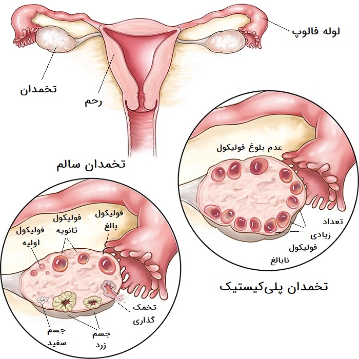 درمان تخمدان پلی کیستیک