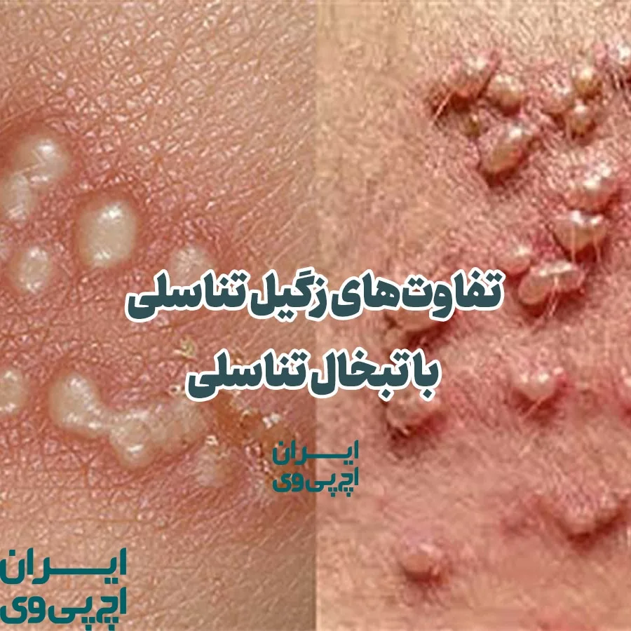 نشانه های زگیل تناسلی