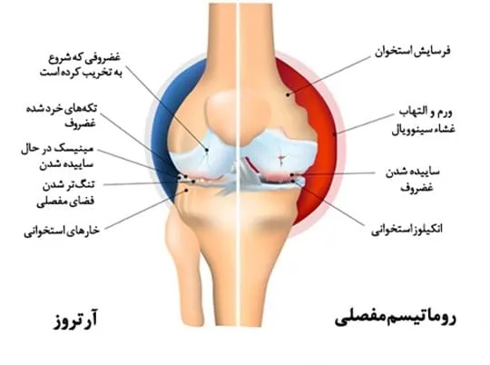 درمان روماتیسم مفصلی
