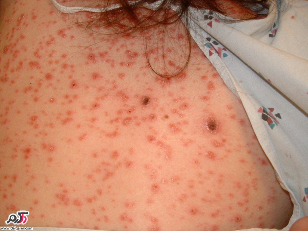 تشخیص سیفلیس