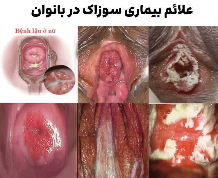 علائم سوزاک در زنان
